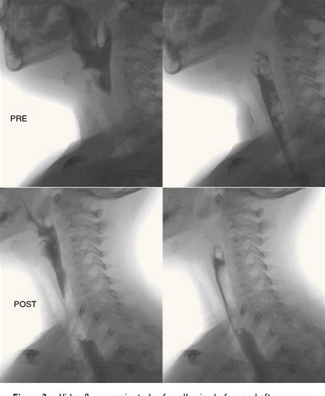 Figure 3 from Laryngeal cleft: Diagnosis and endoscopic surgical treatment. Report of 2 cases ...