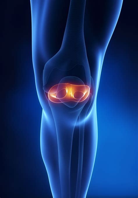 Meniscal Root Tear |Torn Meniscus Root| Orthopedic Knee Specialist ...