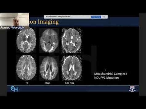 Radiological Diagnosis and Approach to Leukodystrophies - YouTube