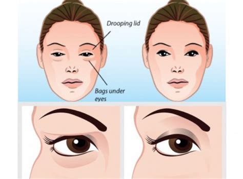 How To Solve your Sagging Eyelids Problem Naturally In 2 Minutes