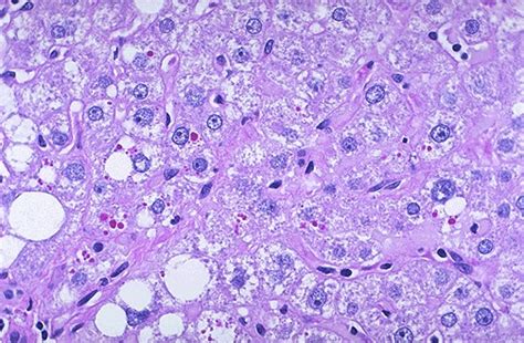 Hepatic Pathology