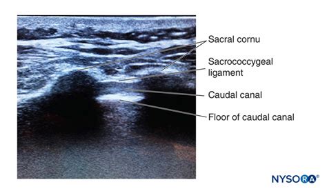 regional-anesthesia-ultrasound-image-depicting-the-sacral-cornua-sacrococcygeal-ligament-caudal ...