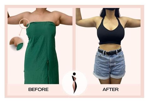 Armpit Fat Removal in Mumbai by Plastic Surgeon | Dr. Amiti Shah | by Dr. Amiti Shah | Plastic ...