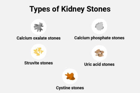 9 Foods That Increase the Risk of Kidney Stones - eMediHealth