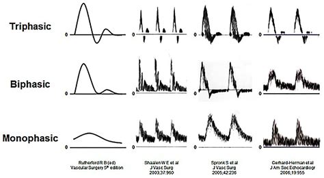 Interpretation of peripheral arterial and venous Doppler waveforms: A consensus statement from ...