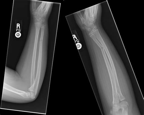 Greenstick Fracture X Ray