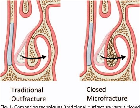 History and Evolution of Turbinate Reduction and Outfracture - Semantic Scholar