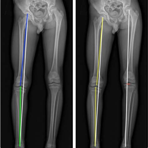 Measurements were performed on long-standing X-rays. a Limb length ...