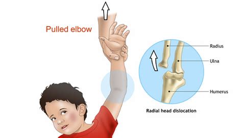 Pulled elbow — Chelsea and Westminster Hospital NHS Foundation Trust