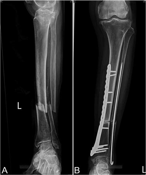 Tibia Fibula X Ray