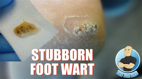 HOW TO TREAT DIFFICULT PLANTAR WARTS REMOVAL - FOOT HEALTH MONTH 2018 ...