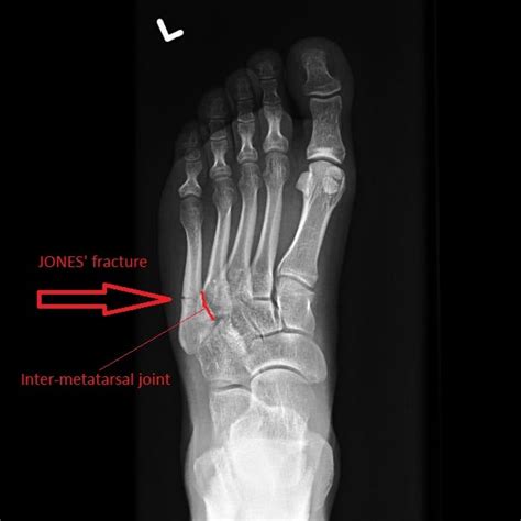 Diagnose on Sight: Fifth Metatarsal Fractures – MED-TAC International Corp.