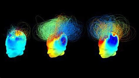 Researchers at Cambridge develop new EEG brain scan - BBC News