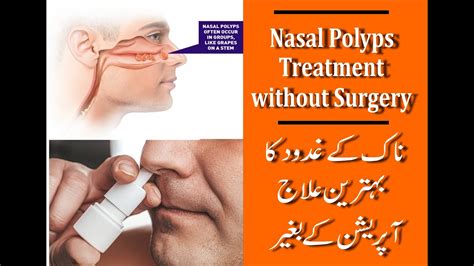 Nasal Polyps How Nasal Polyps Treatment Miracle Helps People Treat | My ...