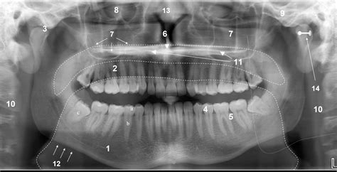 The panoramic dental radiograph for emergency physicians | Emergency Medicine Journal