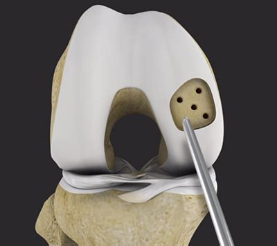 Microfracture Sioux Falls | Articular Cartilage | Cartilage Restoration Sioux Falls