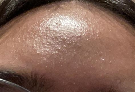 is this normal? how do i get rid of this forehead texture? skin type is dry, acne prone : r/acne