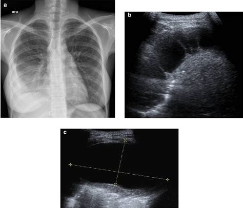 a) Chest radiograph shows a right loculated pleural effusion. (b, c)... | Download Scientific ...