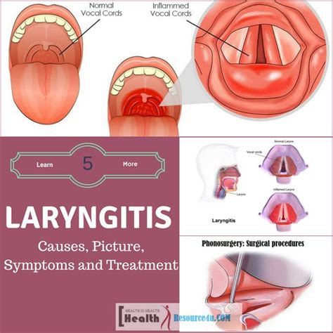 Laryngitis : Causes, Picture, Symptoms and Treatment in 2021 ...