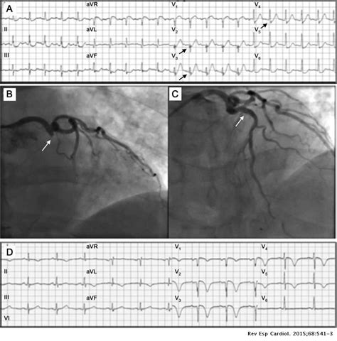 Proximal Left Anterior Descending Artery Acute Occlusion With an Unusual Electrocardiographic ...