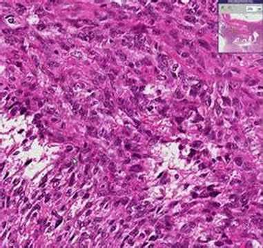 Histopathology Uterus --Leiomyosarcoma - YouTube