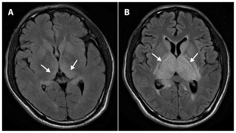 Japanese encephalitis | CMAJ