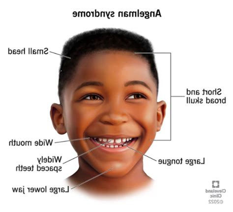 Angelman Syndrome treatments, diagnosis and symptoms in children and adolescents