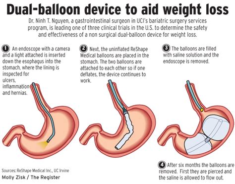 Doctors to study stomach balloon for weight loss – Orange County Register