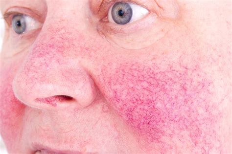 Underlying Etiologies of Cutaneous Flushing - Dermatology Advisor