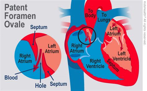 Kidshealth: Patent Foramen Ovale (PFO) | Akron Children's Hospital