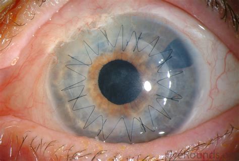 Penetrating keratoplasty (PK)