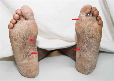 Cureus | Stevens-Johnson Syndrome: A Perplexing Diagnosis