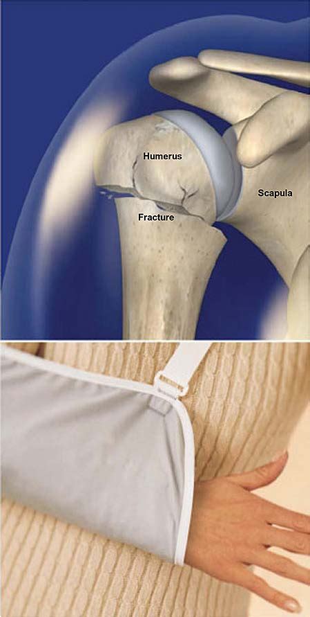 Proximal Humerus Fracture (Broken Shoulder) | Central Coast Orthopedic Medical Group