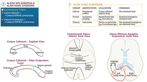 Neuroanatomy: White Matter Commissures & Disconnection Syndromes | Draw ...