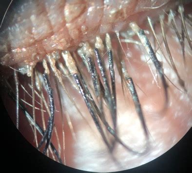 Diagnosing Demodex | The Dry Eye Treatment Center