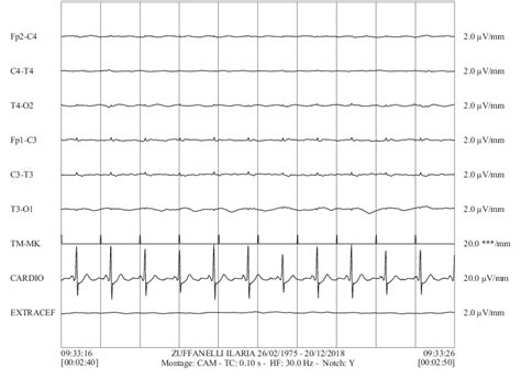 Isoelectric EEG recorded 24 h after resuscitation. | Download ...