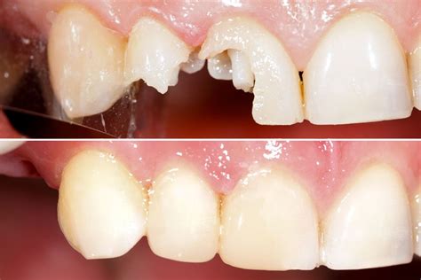 Before and After Dental Treatments – Metropolitan Smiles