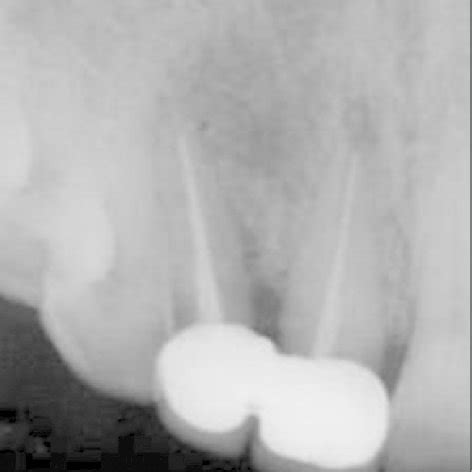 Intraoral periapical radiograph after 18 months | Download Scientific Diagram