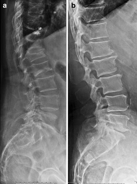 A X-ray osteoporotic vertebral fracture versus X-ray metastatic... | Download Scientific Diagram