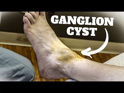 Ganglion Cyst Foot Surgery Recovery Time - The Complete Guide!