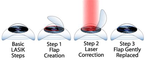 Laser & Lasik Eye Surgery Guide - How It Works, Cost, & Risks - Find Health Tips