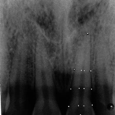 Intraoral periapical radiographs taken using paralleling technique | Download Scientific Diagram