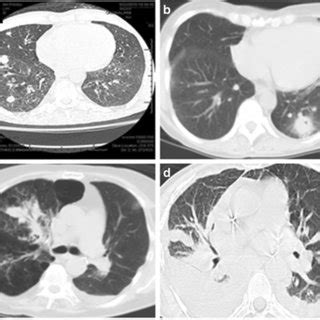 Chest CT shows diffuse peribronchial infiltrates and bronchial wall... | Download Scientific Diagram