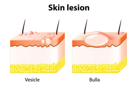 Skin Lesions: Symptoms, Causes And Treatment – SkinKraft