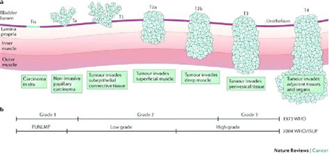 Bladder cancer WHO 1973 and 2004 staging of urothelial tumors (24) a ...