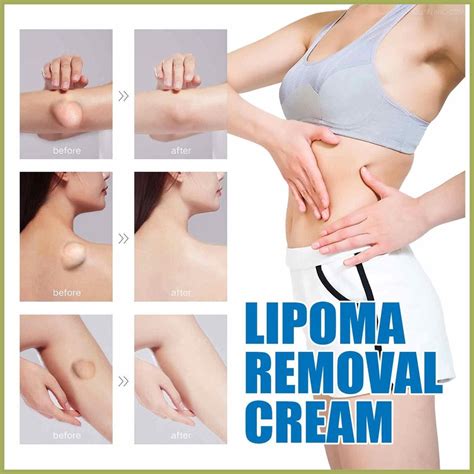 Lipoma Cyst Removal Cream Lipoma Fatty Removal Instant Lipoma Removal Balm Herbal Lipoma Lumps ...