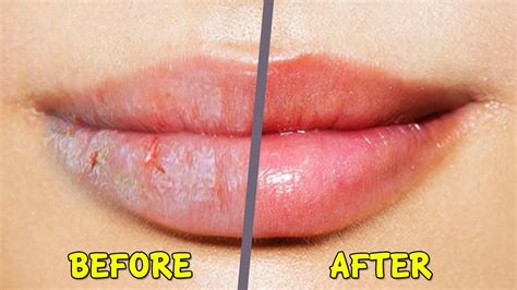8 Homemade Remedies for Dry and Chapped Lips - Skin Care Top News