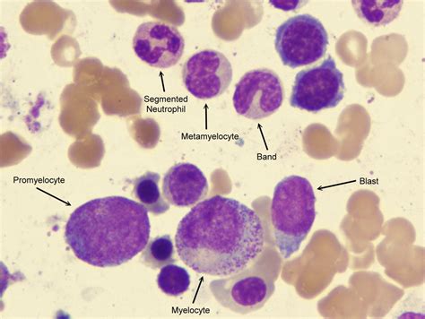 promyelocytes and blasts - Google Search | Medical laboratory, Medical laboratory science ...