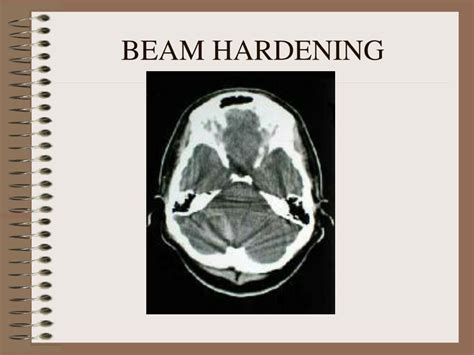 Beam Hardening Artifact Ct Scan - The Best Picture Of Beam