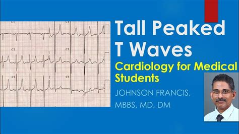 Peaked T Waves